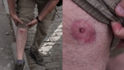 Gazetari i plagosur thotë se policia gjeorgjiane përdori plumba gome kundër protestuesve